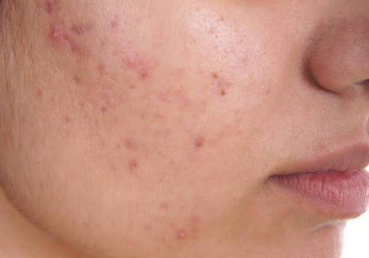 Acne: Cause, Treatment, Types And Skincare - Mehr Skincare